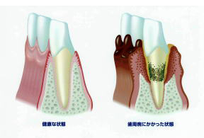 歯周病治療について