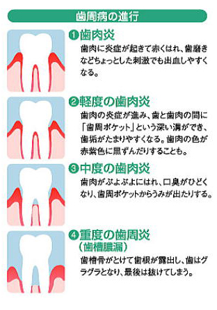 歯周病治療について